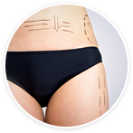 Cirugía de contorno corporal